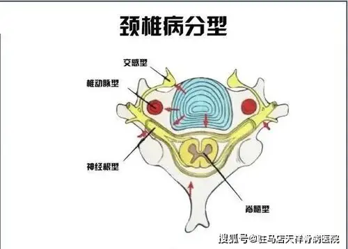 非遗老张家膏贴科普最不可忽视的脊柱疾病颈椎病