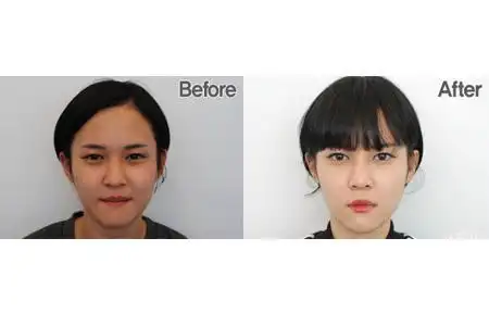 鼻头缩小术对比照(图片来源:阳光 整形外科)