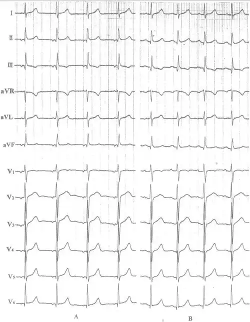 二,加速的房性逸搏心律-12导联心电图同步诊断学-医学