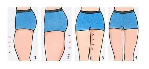 小编解析大象腿是怎么来的