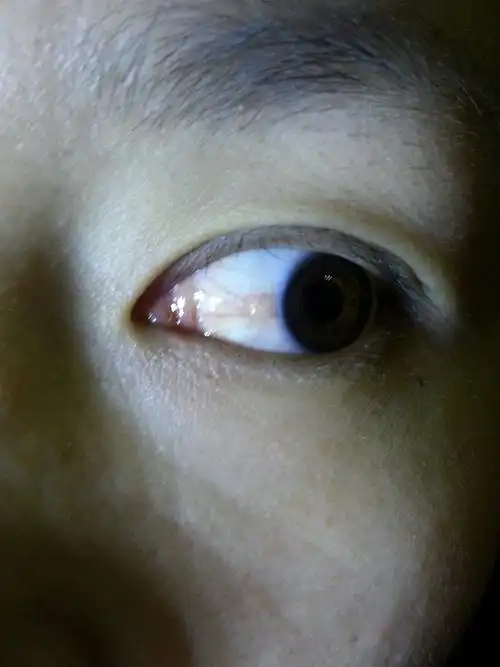 问:眼睛里张了个泡泡也有点像个肉块,有点痒.眼睛也蛮疲劳的