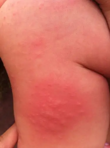 宝宝五个多月,身上一夜之间长了好多小红疙瘩,是什么啊?