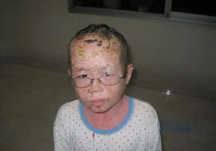 一个坚强的银屑病男孩