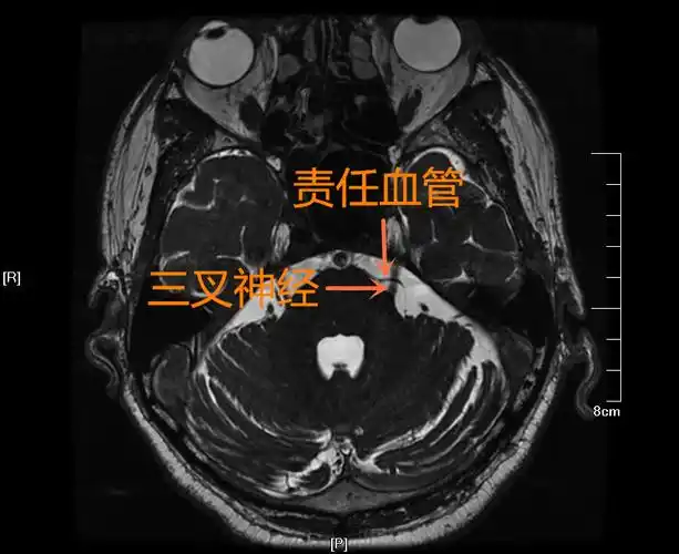【病例-三叉神经痛】左侧面颊部疼痛4年,mvd术后疼痛消失