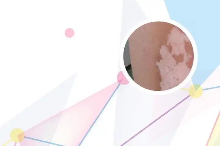 吃槟榔嘴巴有白斑怎么办