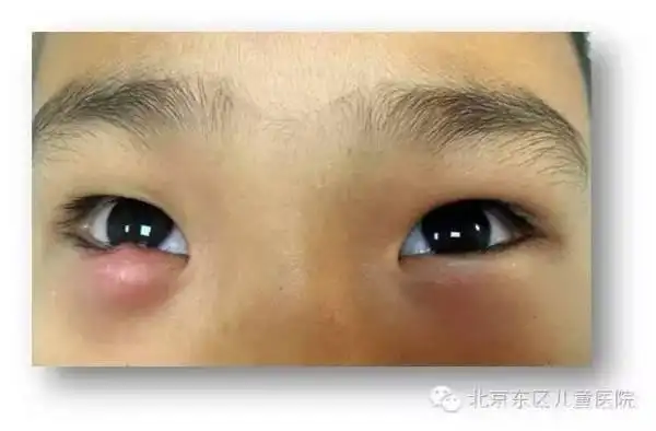 宝宝长了"麦粒肿"该怎么办?注意!严重了可得做手术!