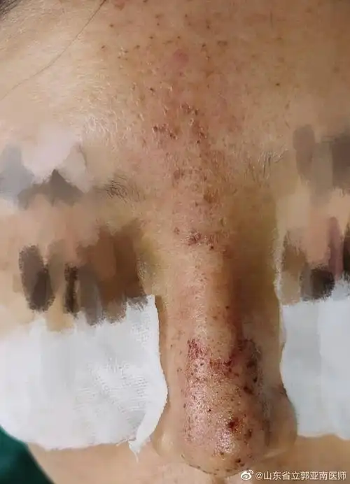 玻尿酸隆鼻栓塞后的治疗