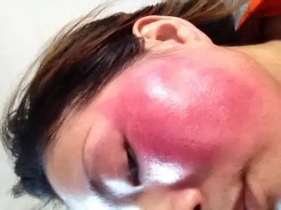 皮肤过敏红肿脱皮怎么办