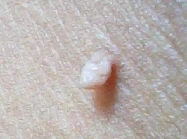 首先这个小肉球叫做"皮赘"如果有密集恐惧症的人肯定还会觉得有点难受