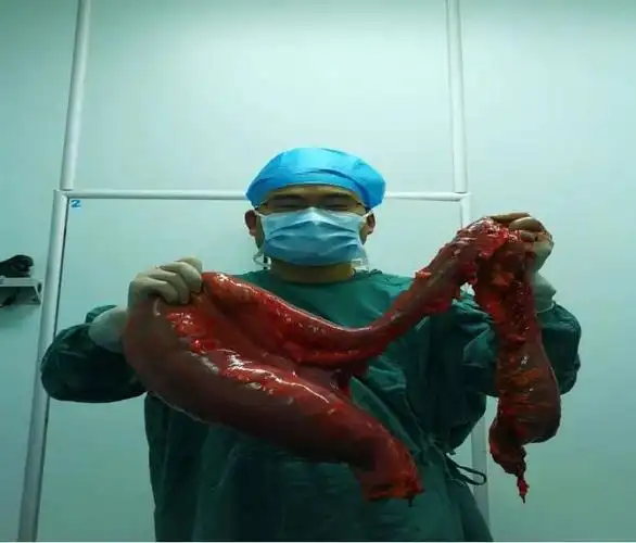 六旬大伯肚大如孕妇,"掏粪男孩"们从中取出巨形