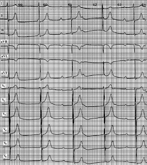 房室交界性逸搏和逸搏心律