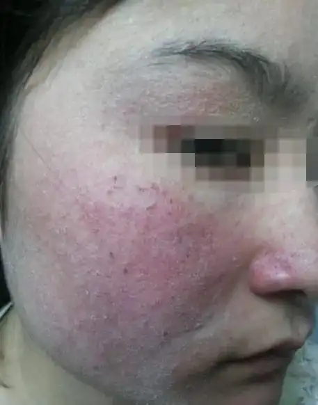 激素痘痘和寻常痘痘是不同的!