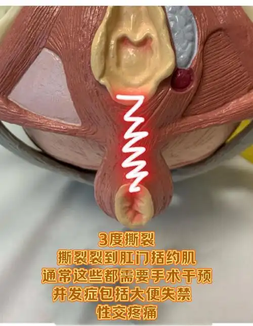 顺产阴道撕裂的四个等级##十顺九裂#  1度撕裂  这是最不严重的撕蜒