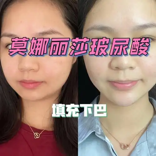 莫娜丽莎玻尿酸填充下巴