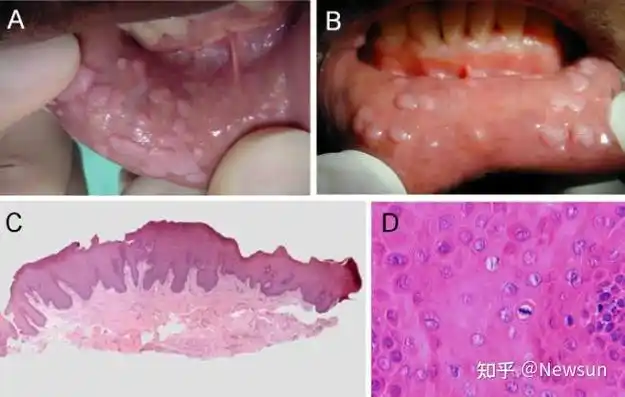 口腔hpv感染都有哪些症状?(附图片) - 知乎