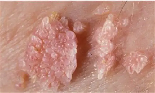 性病性淋巴肉芽肿套图 (46)_有来医生