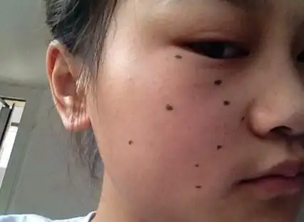 七星痣一般在什么地方