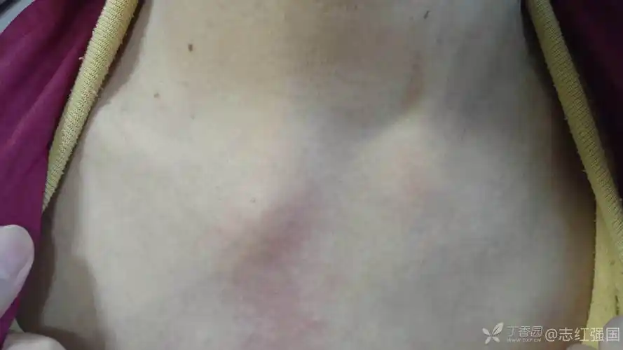 胸锁关节半脱位