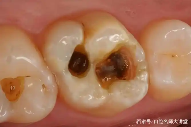 牙科医生讲义第八讲:牙体缺损的病因,影响,种类