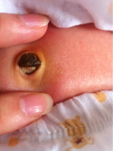 急,请有经验的宝妈看看这是脐茸吗?