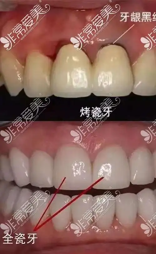 烤瓷牙和全瓷牙实例对比图