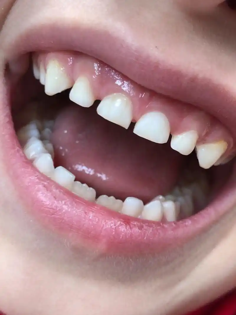 牙缝越来越大怎么办 #牙齿缝隙大#  1,牙周基础治疗:如果牙缝大是由于