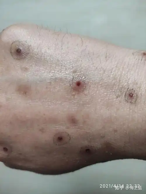 扁平疣激光后的记录 - 知乎