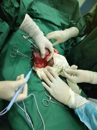 睾丸肿瘤切除术