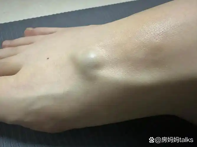 我的脚为什么有个很大的青筋突起?