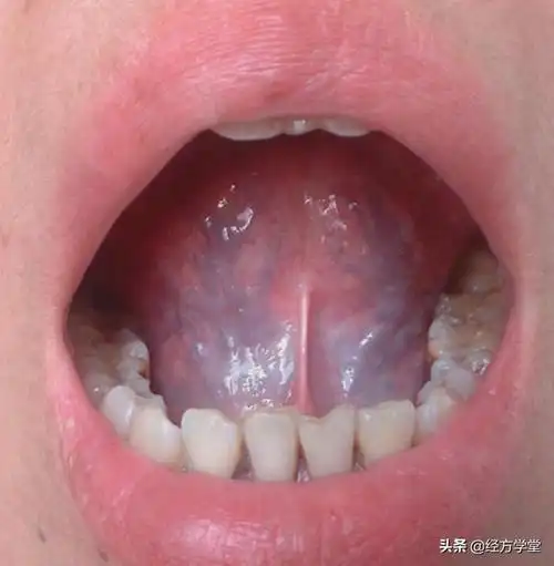 「经方学堂」,一起学习舌诊,教您如何看舌态:正常,舌痿软