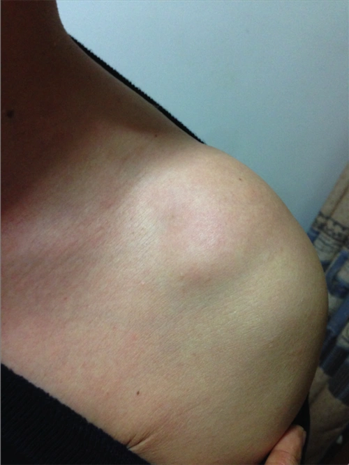 右肘后脂肪瘤图片