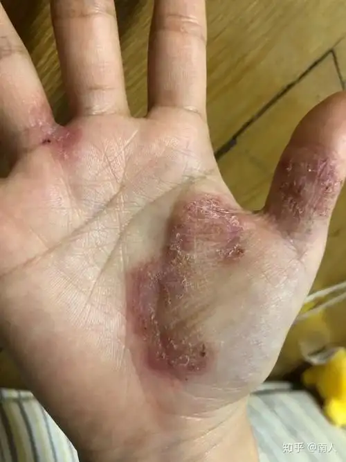 手指水泡型湿疹,手指水泡湿疹图片-图片大观-奇异网