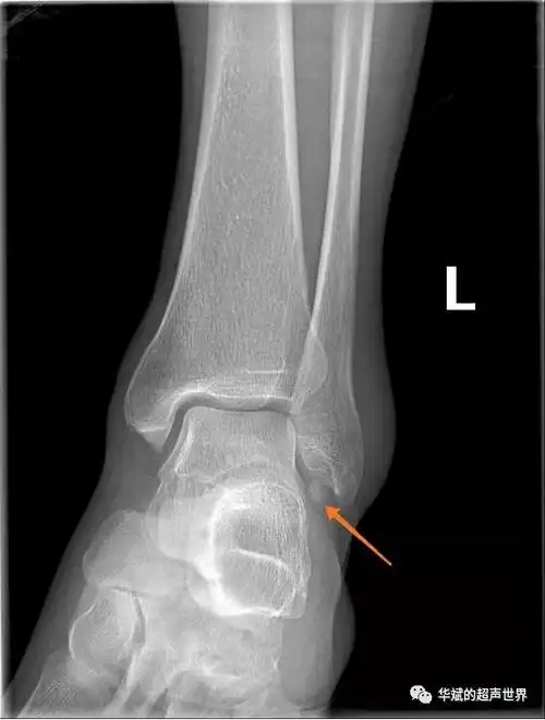 外踝处腓骨内下方箭头所示的的类圆形高密度影,边缘高密度缘完整,腓骨