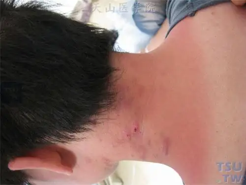 日光暴晒后颈后部鲜红色水肿性红斑,边缘鲜明