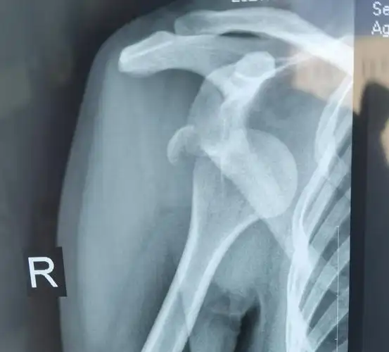 肱骨大结节兵脱位