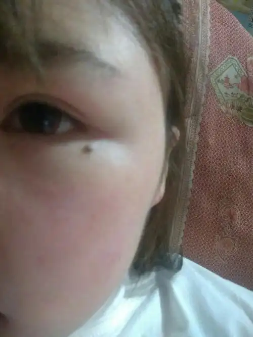 20 这是泪痣吗?这是泪痣嘛?可以详解一下吗?