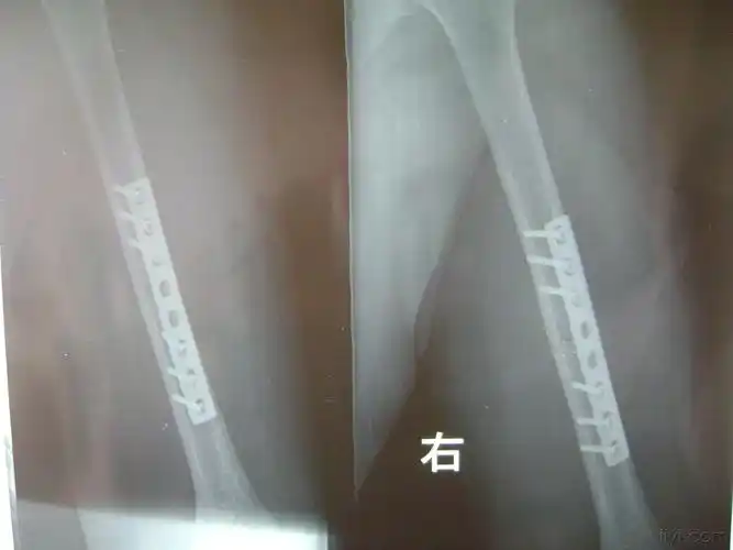 肱骨干干骨折选择什么样的内固定(术后片)