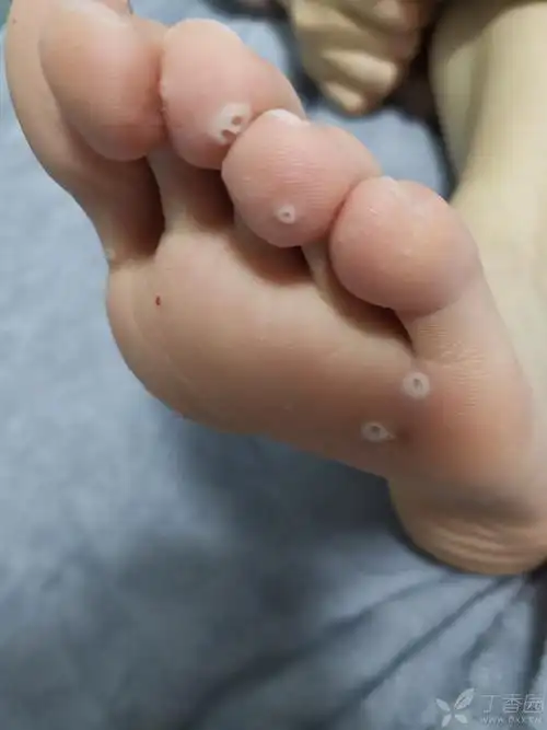 请皮肤科的老师看一下,脚底长的什么东西 [病例帖]