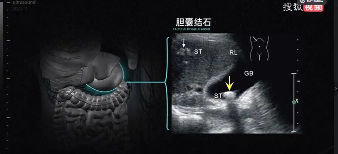 b超"回声"大揭秘:胆结石是怎么被发现的?_超声_图像_反射