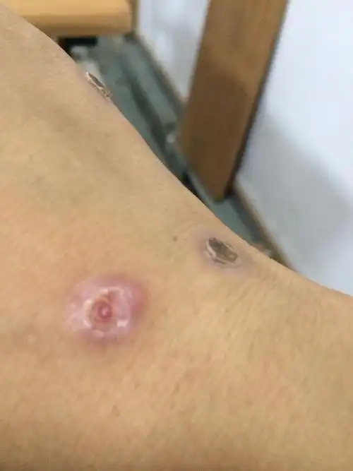 瘊子结痂掉了 现在这样正常吗