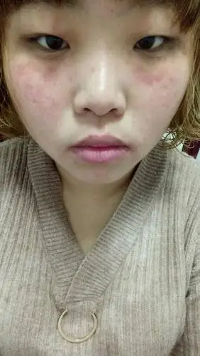 昨天贴的时候刺痛,今天早上就这样了,贴的那里都红了是不是过敏啊