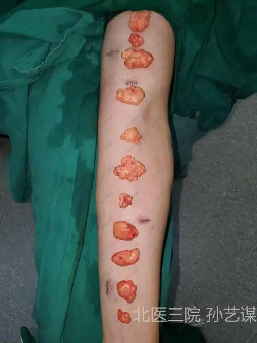 治疗中为此设计小切口脂肪瘤拆除手术.