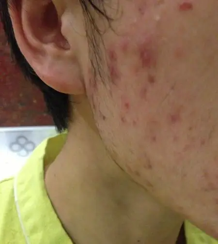 好像是毛囊发炎,怎么办,是吃什么药,还是买抹的药膏? 求药品!