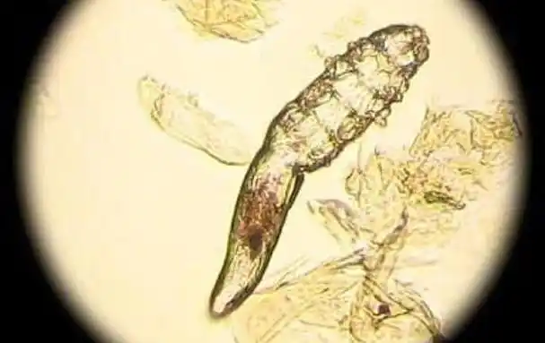 螨虫图片及床上除螨虫比较快的方法