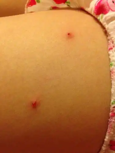 不是过敏.抠破了.里面有一个类似脂肪粒的东西.怎么回事阿.一直不好.