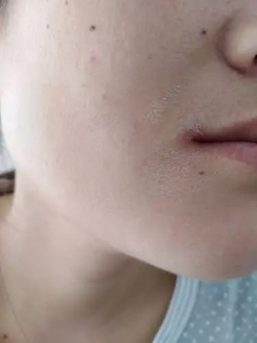 请问嘴角和下巴这种白白的皮屑是什么啊?