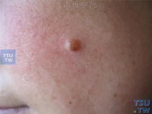 皮内痣:面部约绿豆大小半球形浅褐色结节,表面光滑
