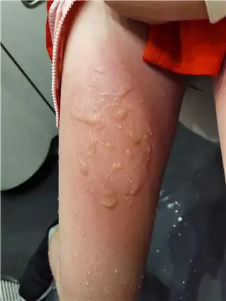 动车上小女孩开水烫伤,附二院医生闻讯紧急施救