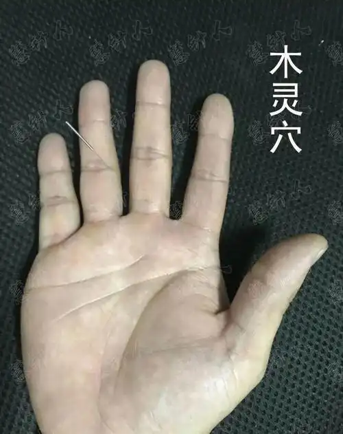 史继霞董氏奇穴木灵穴