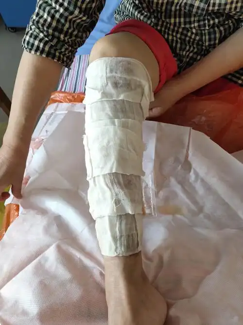 康复新液湿敷(前面)